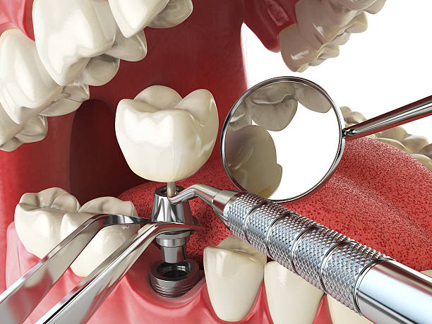 Best Emergency Tooth Extraction in Converse, TX